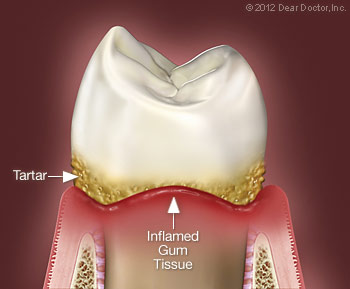 Gum disease.