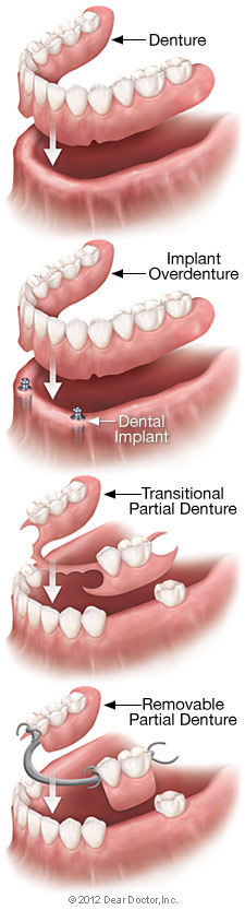 Removable denture types.